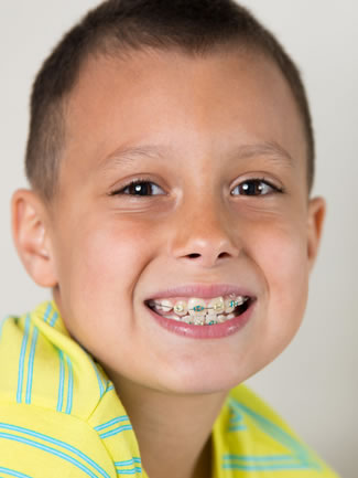 color my braces